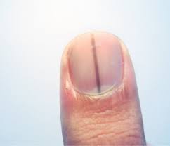 normal black line under fingernail vs