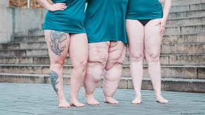 lipedema is not the same as obesity