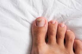 types of toenail fungus pictures