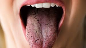 cations could be causing your dry mouth