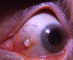 conjunctival cyst epithelial inclusion