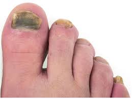 toenail fungus symptoms and treatment