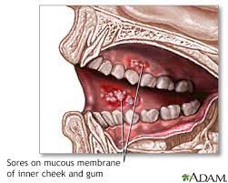 mouth sores information mount sinai