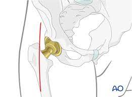 anterior approach for total hip