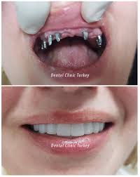 full mouth dental implants full mouth