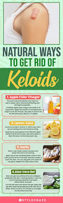 12 home remes to get rid of keloids