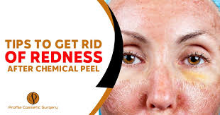 get rid of redness after chemical l