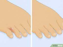 6 ways to get rid of foot fungus wikihow