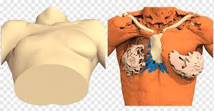 Polandůn syndrom (poland syndrom) a příznaky. Poland Syndrome Pectus Excavatum Surgery Thorax 3d Women Tshirt Woman Arm Png Pngwing