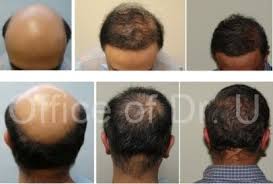 Both males and females can benefit from hair transplant surgery. Hair Transplant Cost Methods Dermhair Clinic Los Angeles 310 318 1500