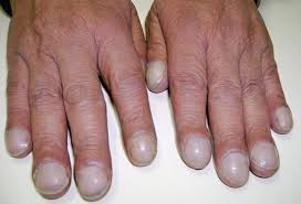 Fingernail And Toenail Abnormalities Nail The Diagnosis