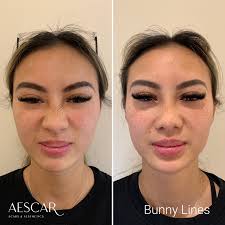 melbourne anti wrinkle injections