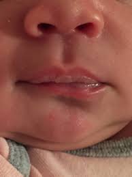 possible blisters on baby s lips pic