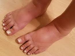 swollen feet and ankles causes