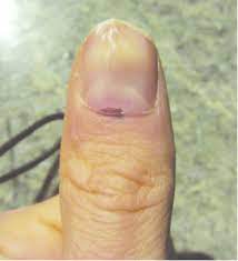 subungual melanoma of the left thumb