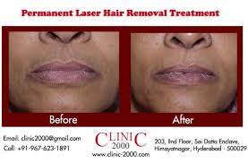 laser treatment for upperlip hair removal