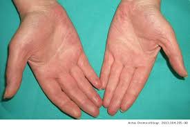 Palmar erythema is reddening of the palms at the thenar and hypothenar eminences. Cutaneous Alerts In Systemic Malignancy Part I Actas Dermo Sifiliograficas