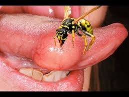 Wasp Stings Man On The Tongue Youtube