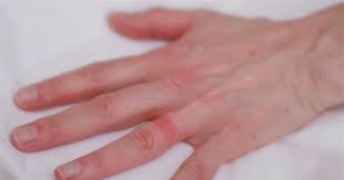 This skin condition causes intensely itchy blisters to develop on the palms of the hands or the soles of the feet. Wedding Ring Rash A Real Life Seven Year Itch