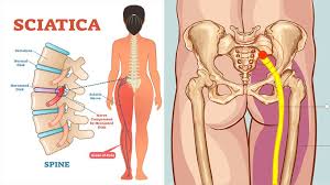 Can we establish a lower bound? Sciatica A Pain In The Bum Literally Equilibrium Sports And Spinal Clinic