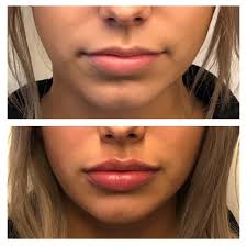 Of course, the results don't last forever, but they are supposed. Lip Injections Dermal Fillers Boss Gal Beauty Bar Columbus Oh