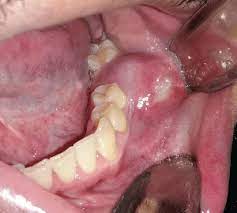 tooth cyst treatment at affordable cost