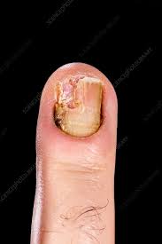 dystrophic finger nail stock image