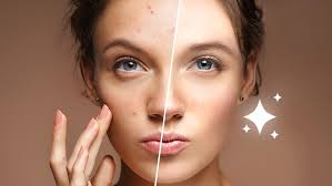 free blemish remover remove acne from