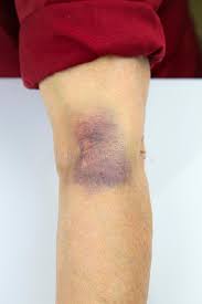 Bildresultat för blåmärken på armen
