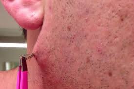 Ingrown hair | compound hair extraction!!! This Guy S Ingrown Hair Is Absolutely Insane Video