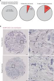 Ncbp2 As2 Is Expressed In The Stroma Of Breast Tumors A