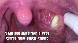 Everything You Need To Know About Tonsil Stones Insider