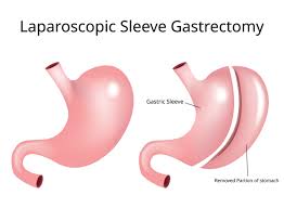 laparoscopic sleeve gastrectomy surgery