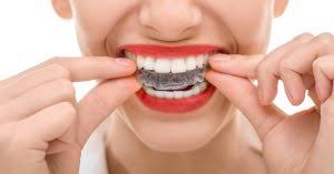 How long does metal braces take to straighten your teeth? What To Know About Brace Removal And After Braces Dental Care Dentist In San Rafael Ca