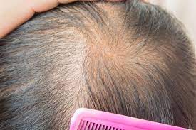 Stress only adds to this. Thinning Hair Causes Types Treatment And Remedies