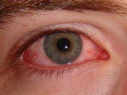 how long does pink eye last 7 signs