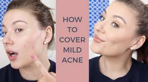 how to cover acne with concealer you