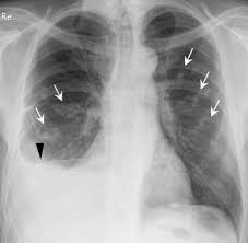 Even if a patient has a history of asbestos exposure and is experiencing symptoms consistent with mesothelioma, doctors must perform a biopsy and other tests to confirm a diagnosis of mesothelioma. Pleural And Peritoneal Mesothelioma Imaging Findings On Ct And Fdg Pet Ct Sciencedirect
