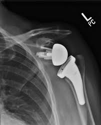 reverse shoulder replacement faq s dr