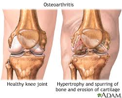 osteoarthritis symptoms and causes