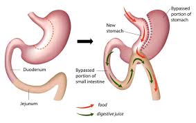 mini gastric byp weight loss surgery