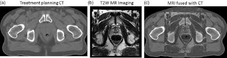 a treatment planning ct of the pelvis