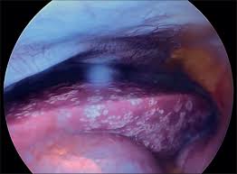 Herpes simplex is a viral infection caused by the herpes simplex virus. Primary Herpes Simplex Virus Type 2 Hepatitis Diagnosed During Laparoscopy The Lancet