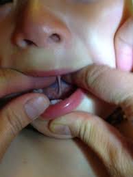 does your baby have a tongue or lip tie