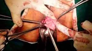 laparoscopic pelvic floor repair
