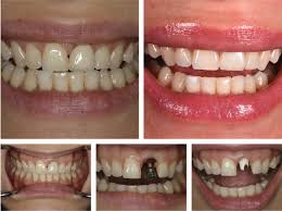 single tooth implants nyc dental