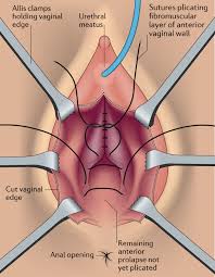 pelvic organ prolapse and ual