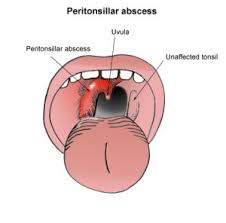 peritonsillar abscess combat cine 101
