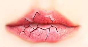 7 tips for treating chapped lips that
