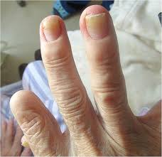 yellow nail syndrome following multiple